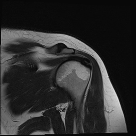 Calcific Tendinitis Supraspinatus Tendon Image Radiopaedia Org