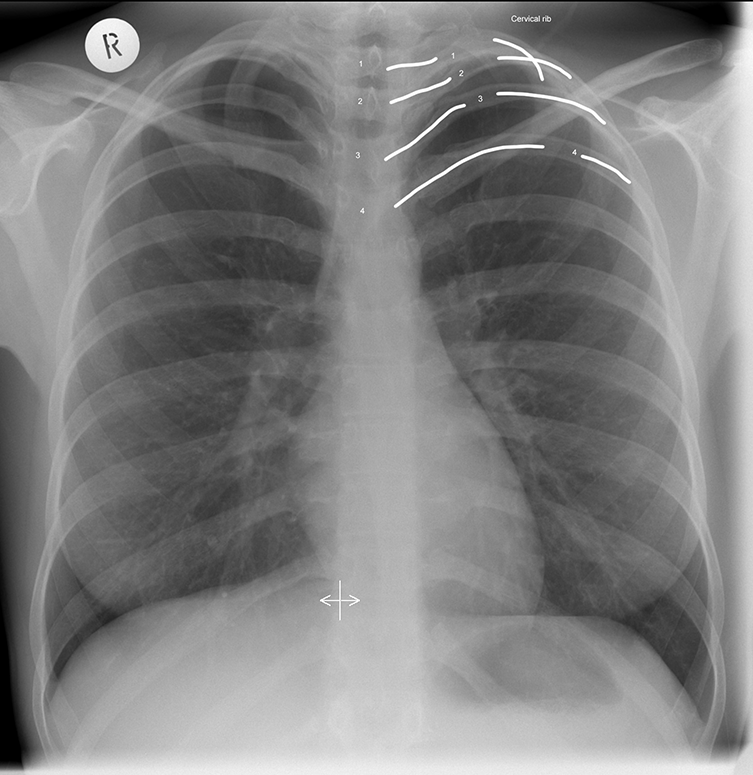 Bilateral Cervical Ribs Left Hypoplastic Image Radiopaedia Org