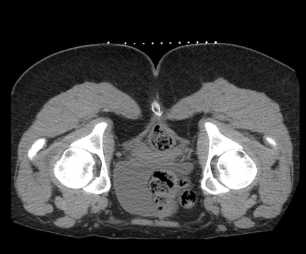 Bilateral Pudendal Nerve Blocks CT Guided Image Radiopaedia Org