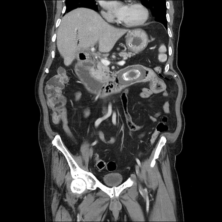 Gallstone Ileus Image Radiopaedia Org