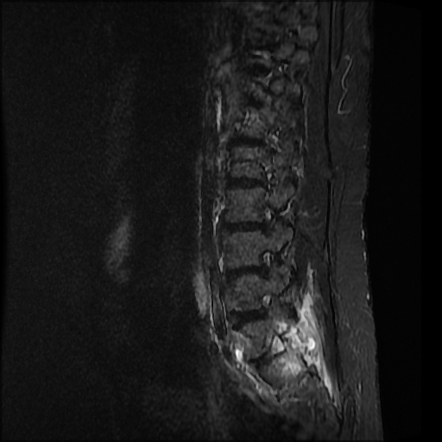 Facet Joint Osteoarthritis Radiology Key Hot Sex Picture