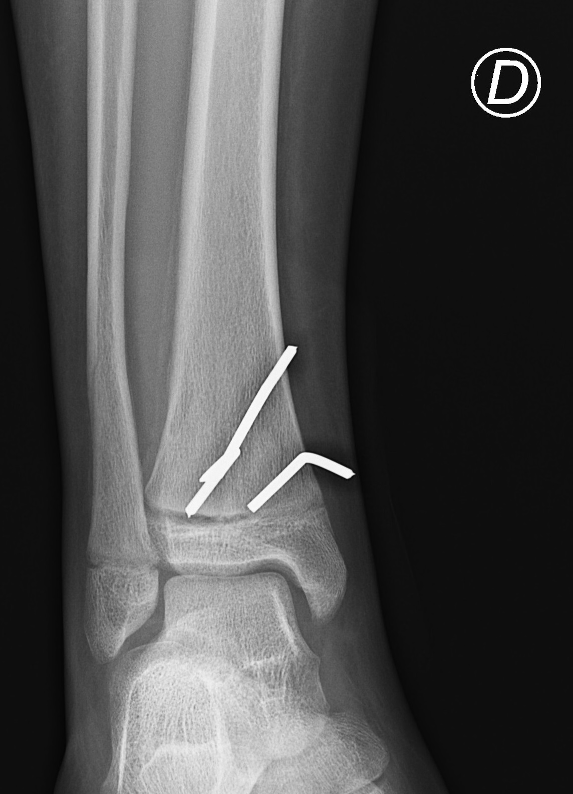 Physeal Arrest Of The Distal Tibia Type II Salter Harris Image Radiopaedia Org