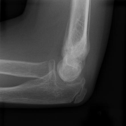 Supracondylar Humeral Fracture Radiology Reference Article My XXX Hot