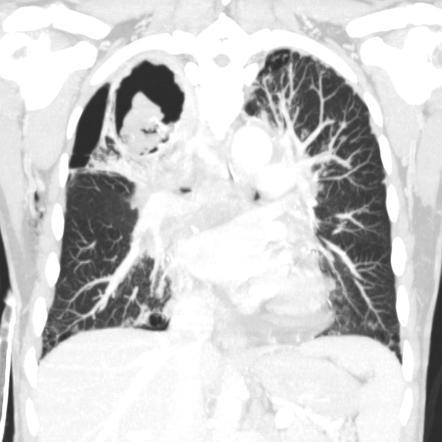 Aspergilloma Radiology Reference Article Radiopaedia Org