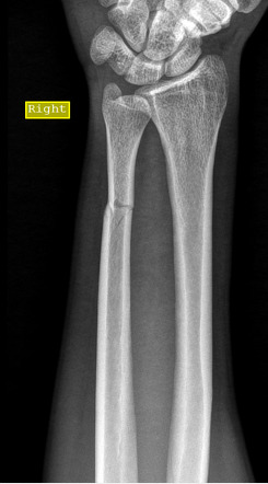 Ulna Fracture Radiology Case Radiopaedia Org