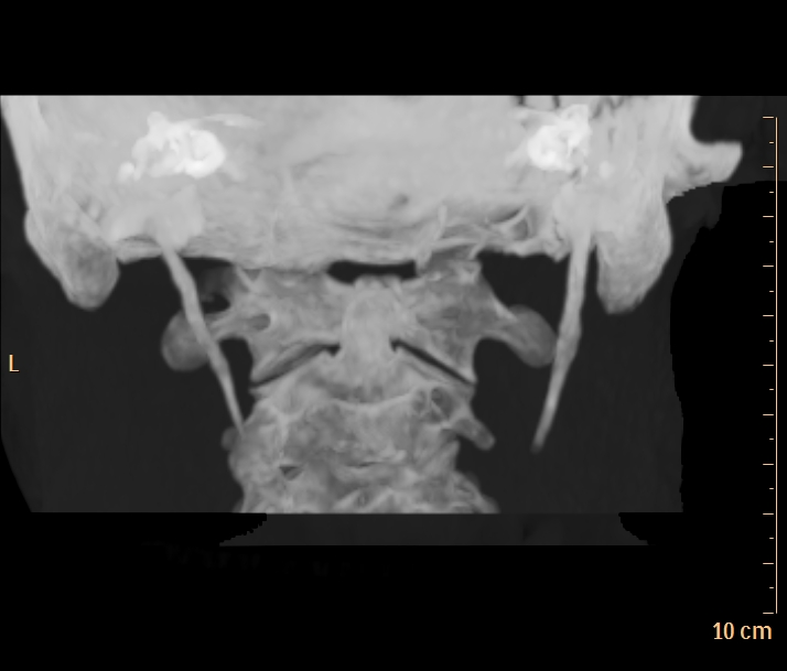 Eagle Syndrome Image Radiopaedia Org