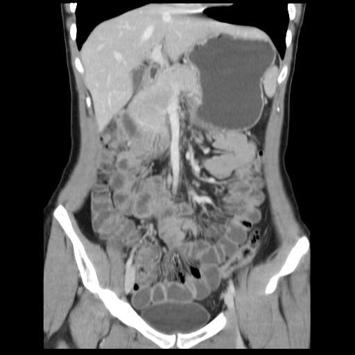 Duodenal Duplication Cyst Image Radiopaedia Org