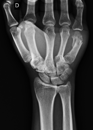 Th Metacarpal Fracture With Follow Up Image Radiopaedia Org