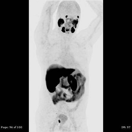 Prostate Cancer Staging F Psma Pet Ct Radiology Case