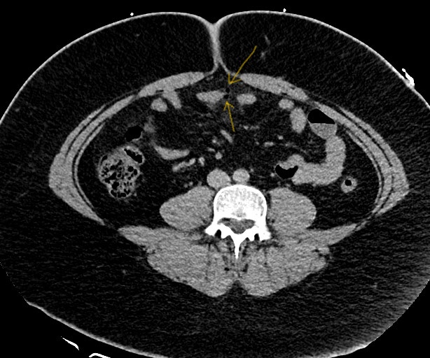 Perforated Meckel Diverticulitis Image Radiopaedia Org