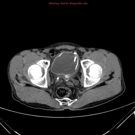 Urinary Bladder Wall Or Lumen Calcification Differential Radiology