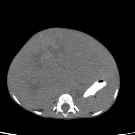 Hepatoblastoma Stage IVb Radiology Case Radiopaedia Org