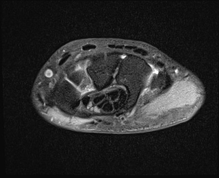 Bifid Median Nerve Ultrasound