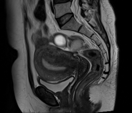 Endometrioma With Adenomyosis Radiology Case Radiopaedia Org