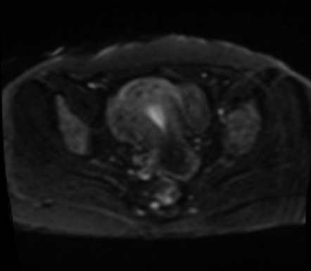 Endometrioma With Adenomyosis Image Radiopaedia Org