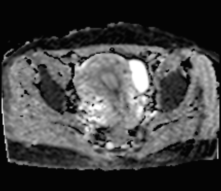 Endometrioma With Adenomyosis Image Radiopaedia Org