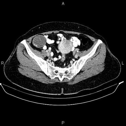 Appendiceal Mucocele Image Radiopaedia Org