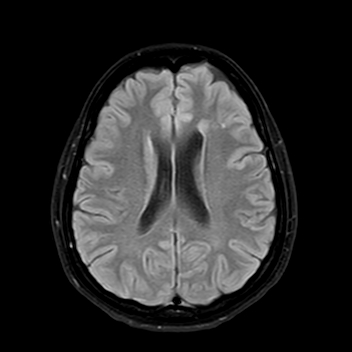 Unilateral Periventricular Nodular Heterotopia Image Radiopaedia Org