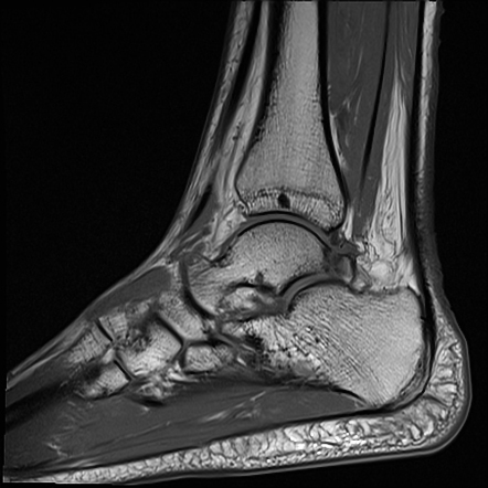 Os Trigonum Syndrome Image Radiopaedia Org