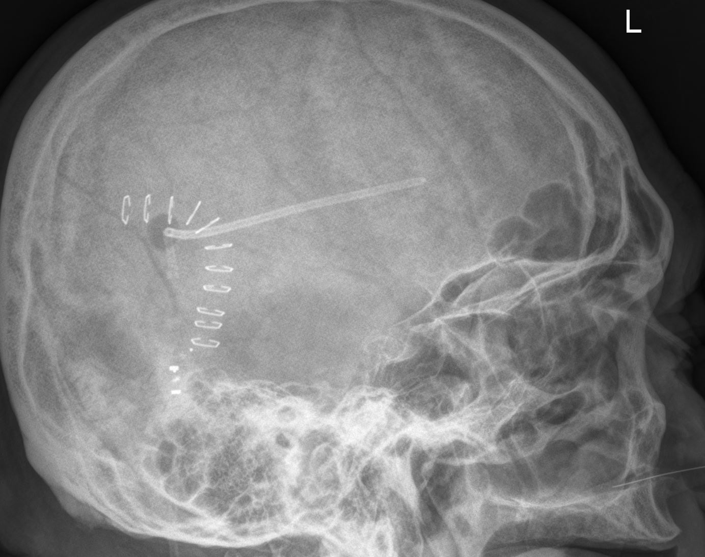 Codman Certas Programmable Shunt Image Radiopaedia Org