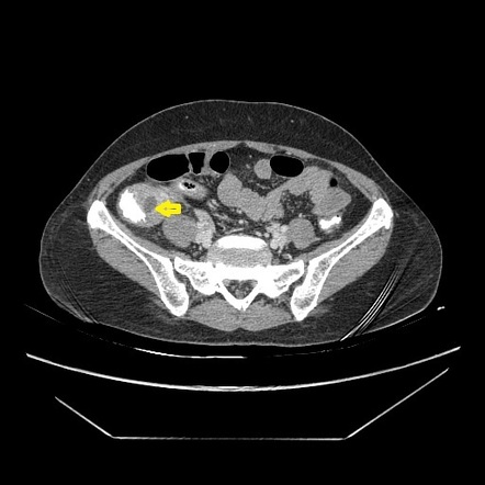 Appendicular Abscess Image Radiopaedia Org