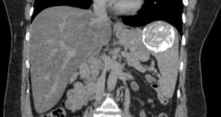 Calcified Hydatid Cyst Of Spleen Radiology Case Radiopaedia Org