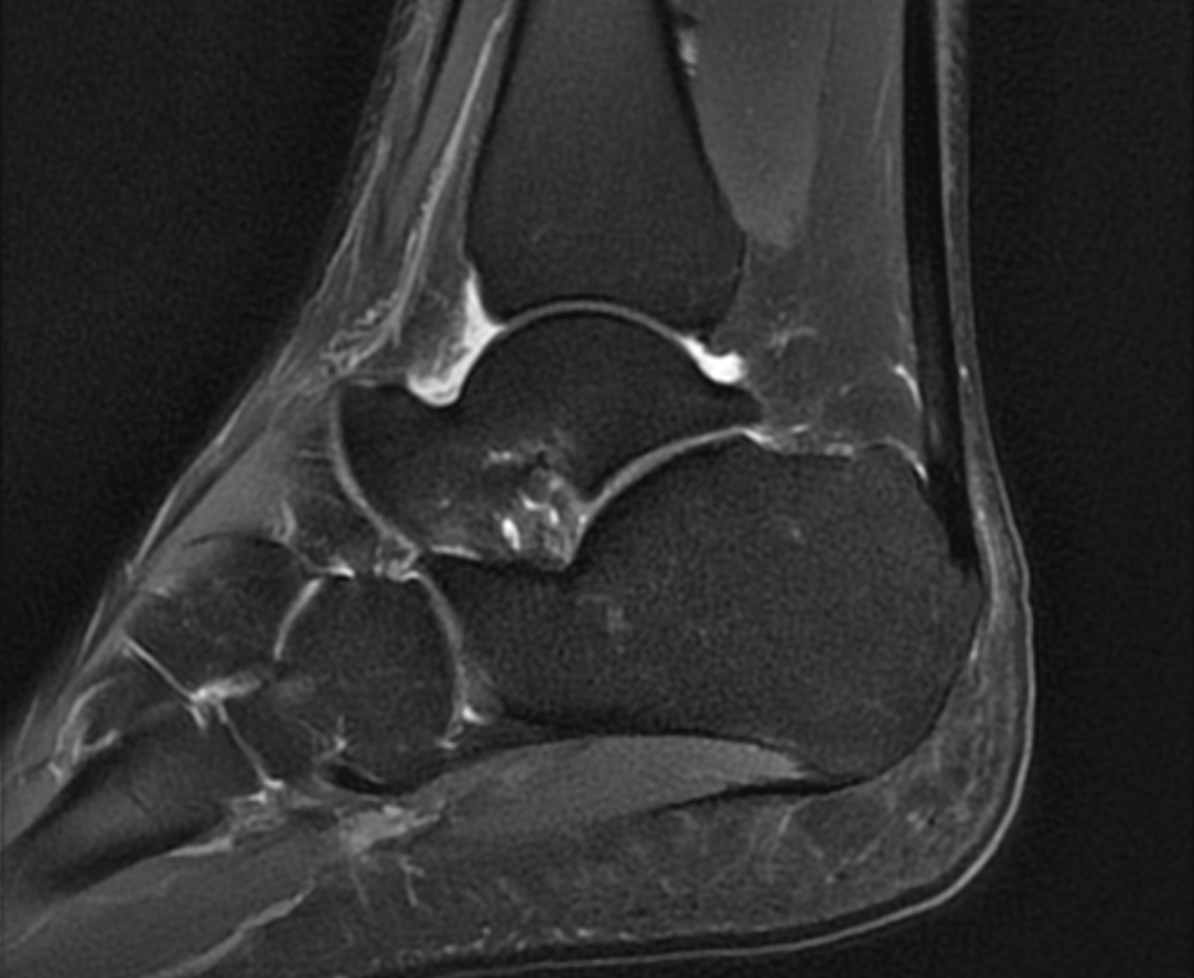 Accessory Navicular Syndrome Image Radiopaedia Org