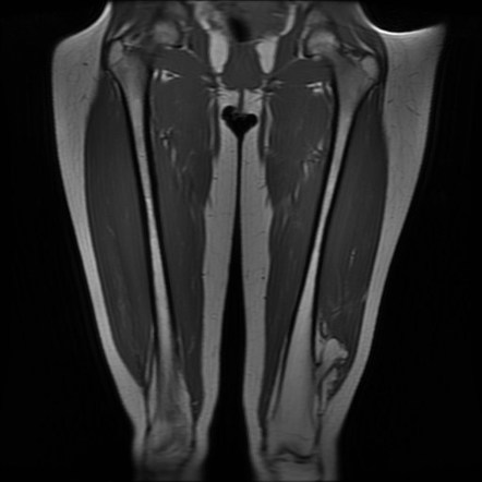 Osteochondroma Image Radiopaedia Org