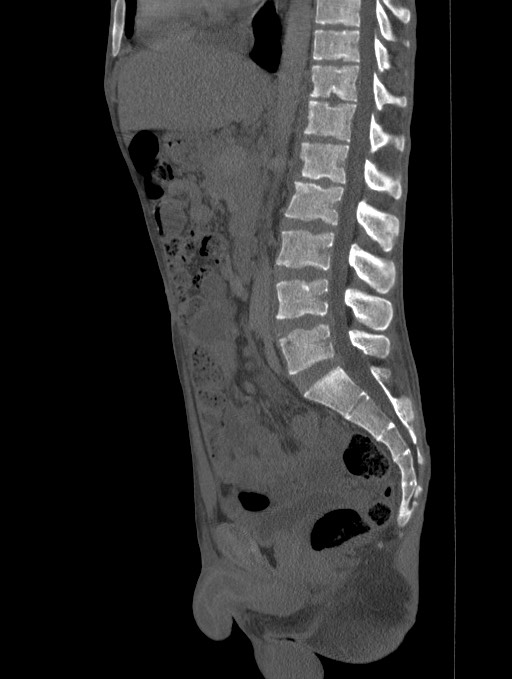 Disseminated Tuberculosis With Spondylitis Pott Disease And Massive