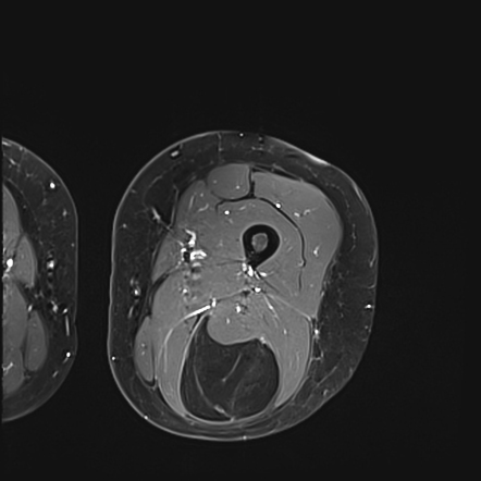 Lipoma Vs Well Differentiated Liposarcoma Radiology Reference Article