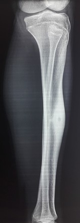 Osteoid Osteoma Tibia Radiology Case Radiopaedia Org