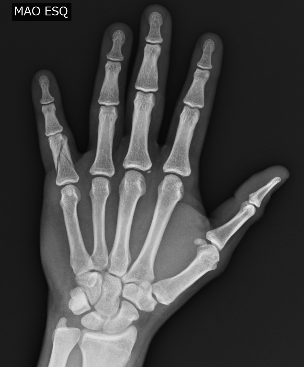 Comminuted Fracture Of The Proximal Phalanx Image Radiopaedia Org