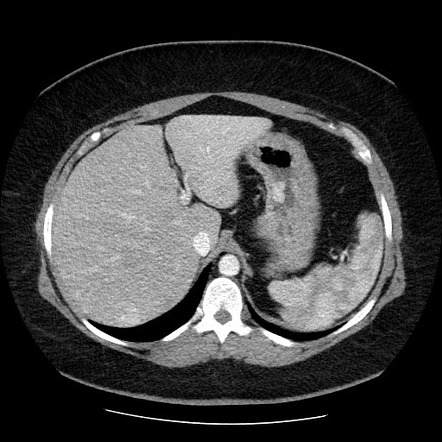 Neuroendocrine Tumors Radiology Reference Article Radiopaedia Org