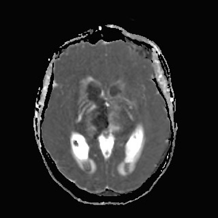 Cerebral Venous Thrombosis With Hemorrhagic Venous Infarction Image