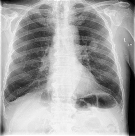 Solitary Pulmonary Nodule Lung Cancer Radiology Case Radiopaedia Org