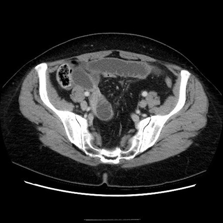 Closed Loop Small Bowel Obstruction Due To Adhesive Bands Early And