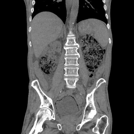 Emphysematous Pyelonephritis Radiology Reference Article