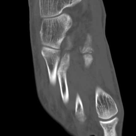 Hallux Sesamoid Fracture Image Radiopaedia Org