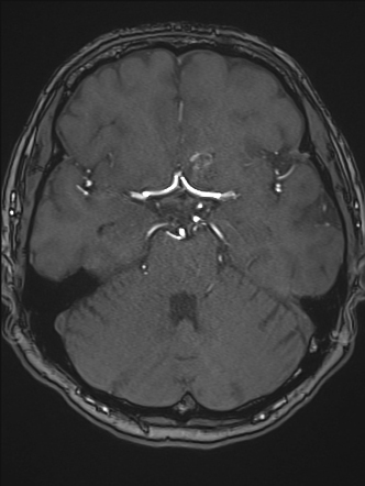 Cerebral Arteriovenous Malformation Image Radiopaedia Org