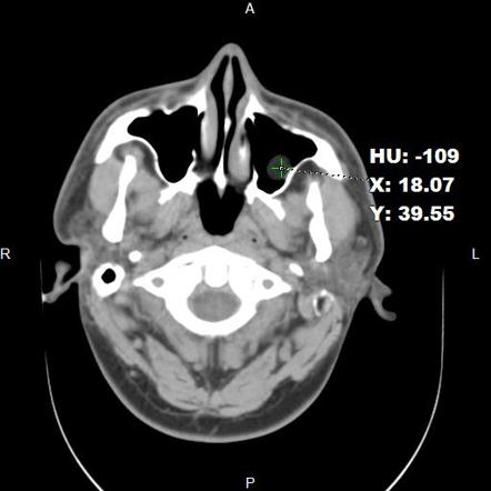 Paranasal Sinus Mucocele Radiology Reference Article Radiopaedia Org