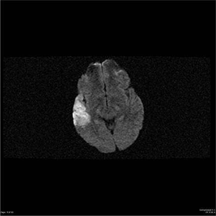 Subacute Cerebral Infarction Image Radiopaedia Org