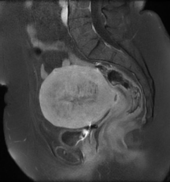 Diffuse Uterine Adenomyosis Image Radiopaedia Org