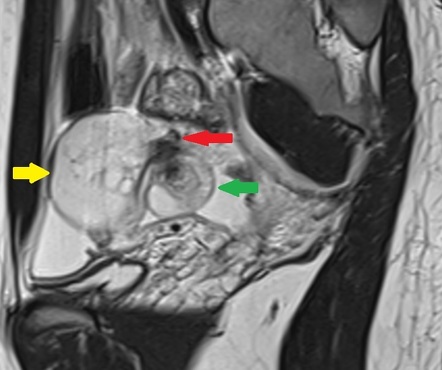 Ovarian Torsion Radiology Reference Article Radiopaedia Org