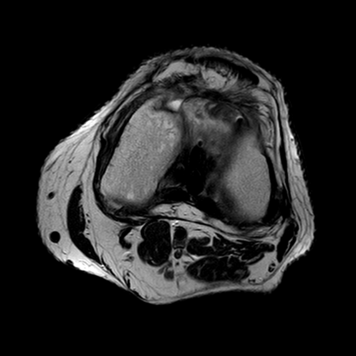 Cyclops Lesion Arthrofibrosis Image Radiopaedia Org