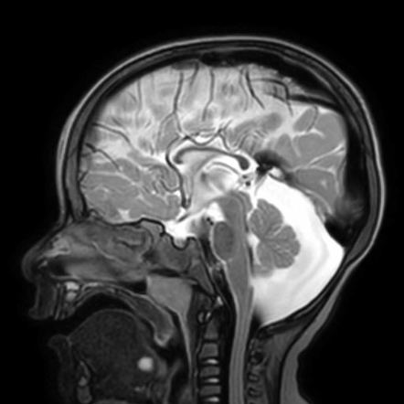 Thyroglossal Duct Cyst Radiology Case Radiopaedia Org