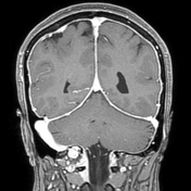 Intracranial Hypotension Radiology Reference Article Radiopaedia Org