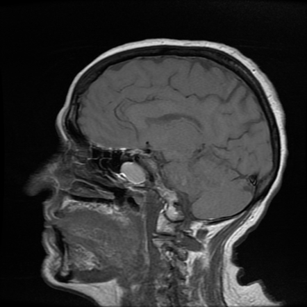 Paranasal Sinus Mucocele Radiology Reference Article Radiopaedia Org