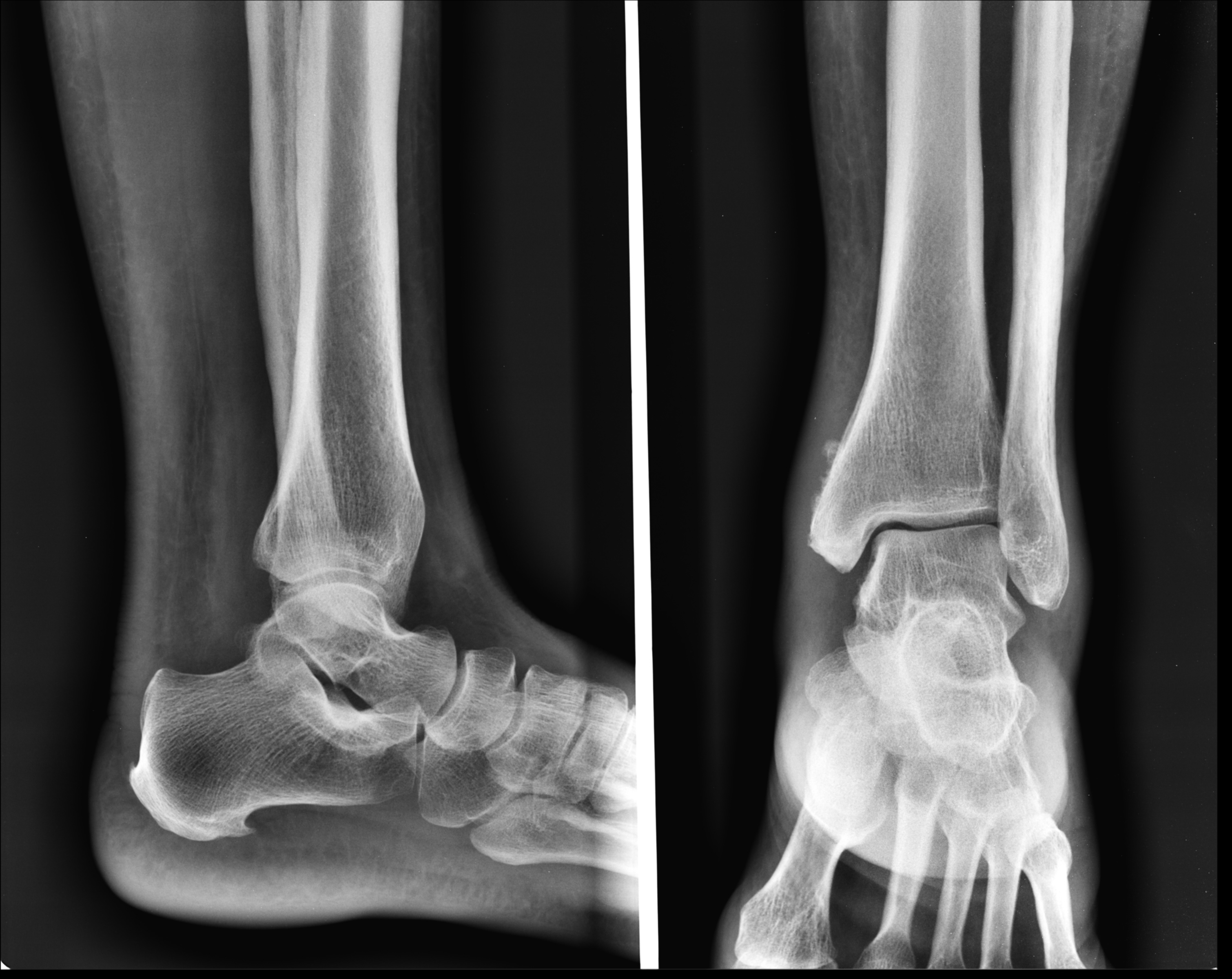 Right Foot X Ray