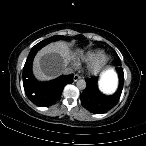 Hepatic Hydatid Cysts Image Radiopaedia Org