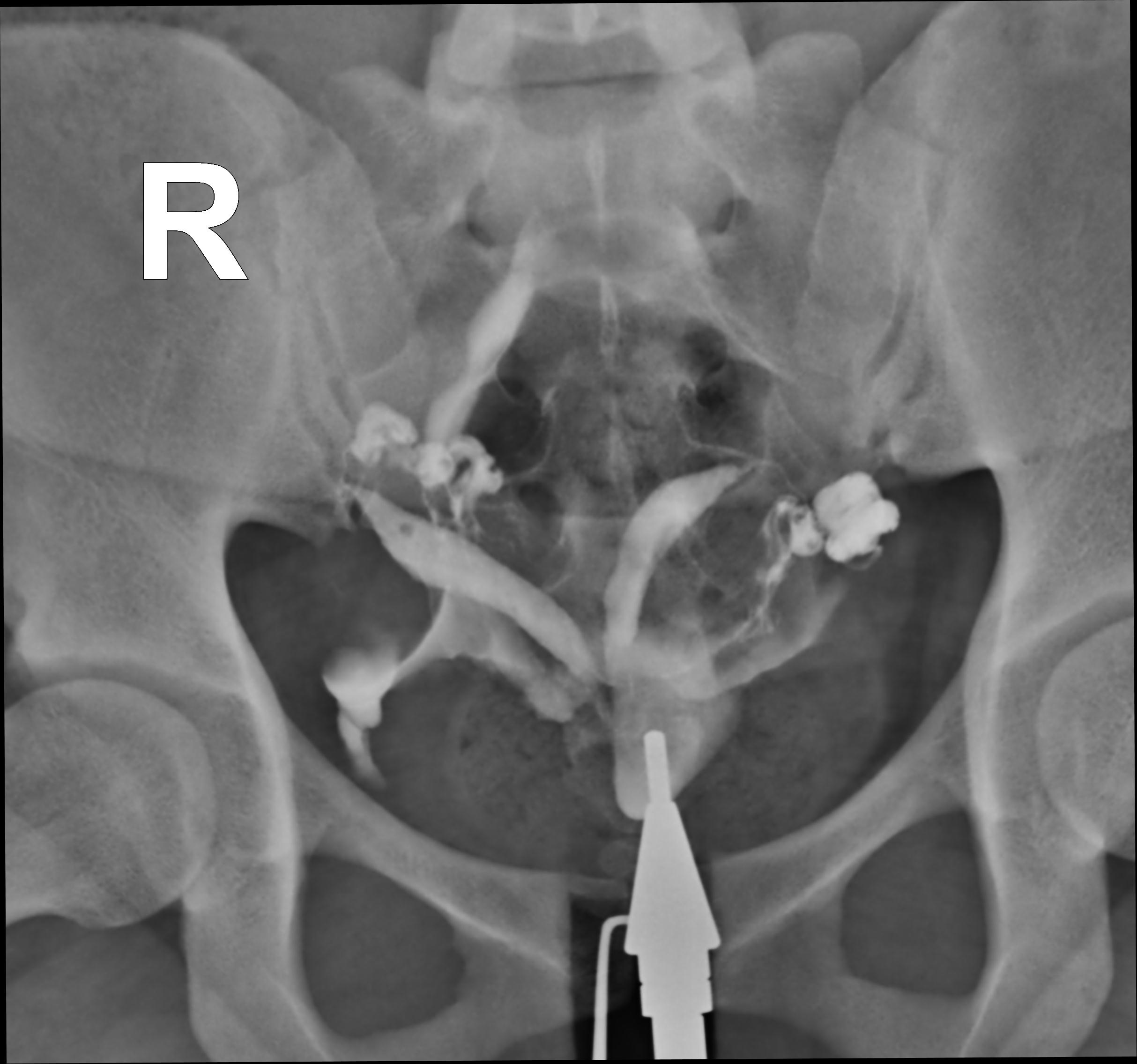 Uterus Didelphys Image Radiopaedia Org